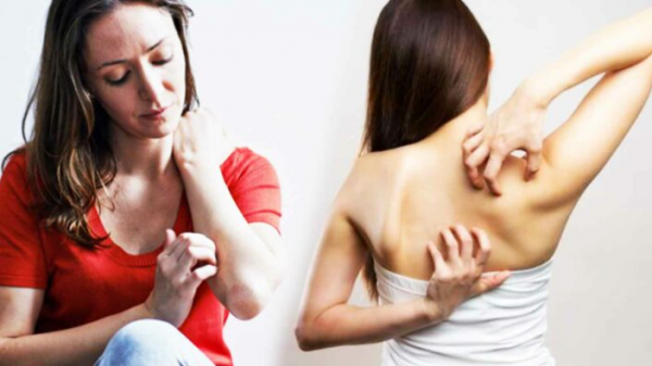 গরমে ঘামাচি দূর করার সহজ উপায়