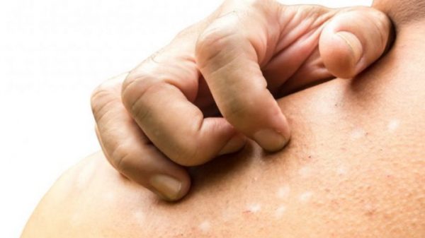 ছুলির সমস্যা থেকে মুুক্তি পেতে কী করবেন?