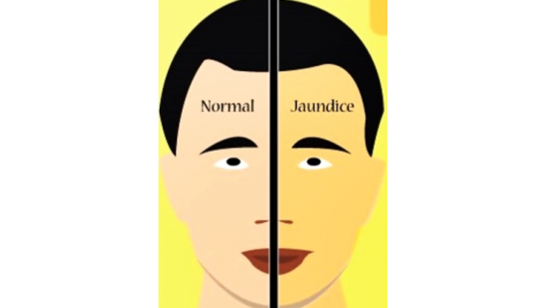 জন্ডিস কোনো রোগ নয়, করণীয় কী?-জেনে নিন বিশেষজ্ঞ পরামর্শ