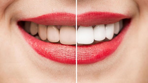 যে উপায়ে দূদাঁতে পোকা বলতে কিছু নেইর করবেন দাঁতের দাগ