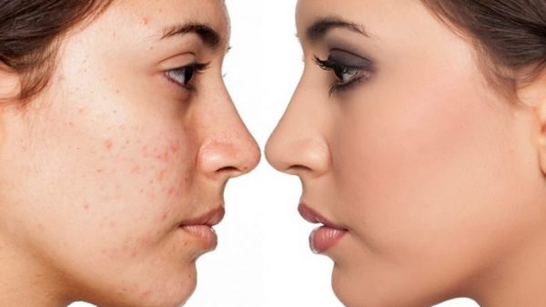 ব্রণের সমস্যায় যা করবেন