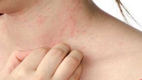 ধুলার অ্যালার্জিতে বিরক্ত? প্রতিত্রাণের ৭ উপায়