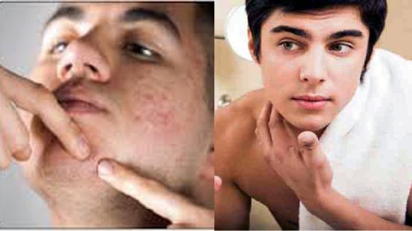 ছেলেদের ব্রণ বেশি হয় কেন?