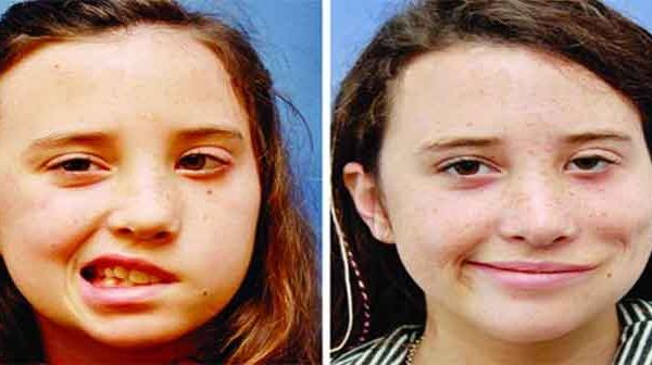 হঠাৎ মুখ বেঁকে গেলে যা করবেন