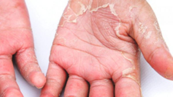 এ সময় হাত-পায়ের চামড়া ওঠা বন্ধে যা করবেন