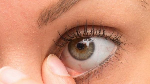 চোখের পাতায় খুশকি কেন হয়?